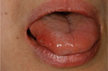 舌潰瘍